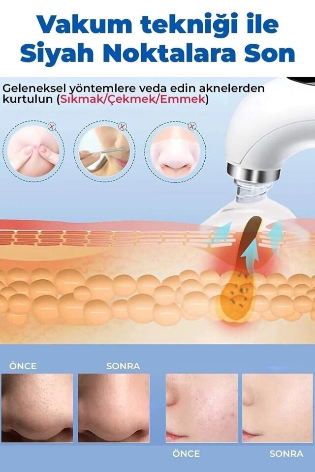 Sterilizasyonlu Vakumlu Cilt Gözenek Siyah Nokta Akne Sivilce